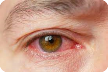 Iperemia congiuntivale: conseguenza alla cura per il glaucoma